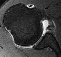 MRI Enlocated Biceps Tendon